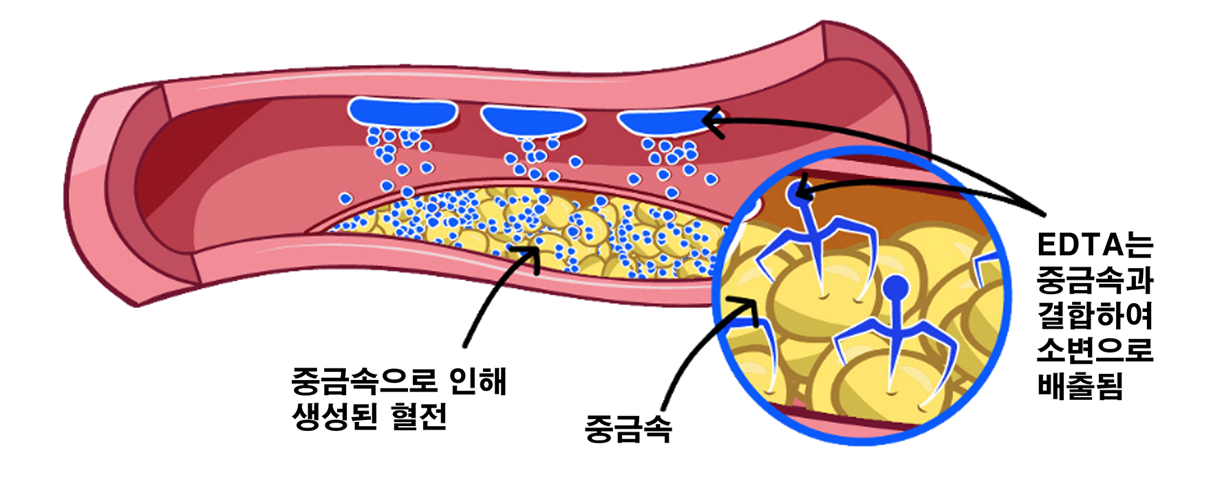 킬레이션 치료의 원리를 나타내는 이미지